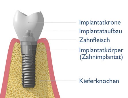 Implantataufbau