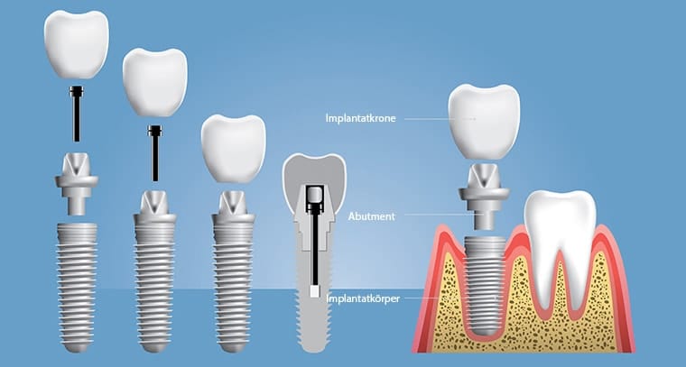 Zahnimplantat – schnell erklärt