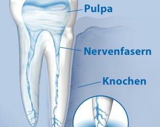 Wann ist eine Wurzelspitzenresektion erforderlich?