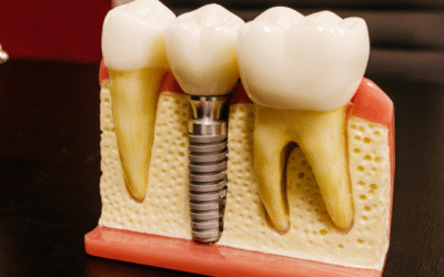 Wie lange dauert das Implantat-Setzen wirklich?