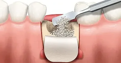 Was ist ein Knochenaufbau beim Zahnimplantat? Teil II