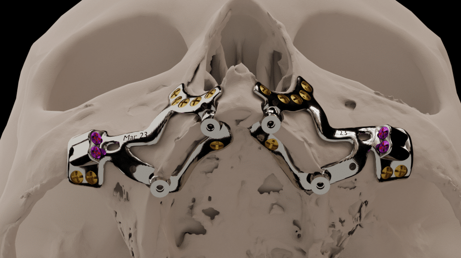 Implantataufbau
