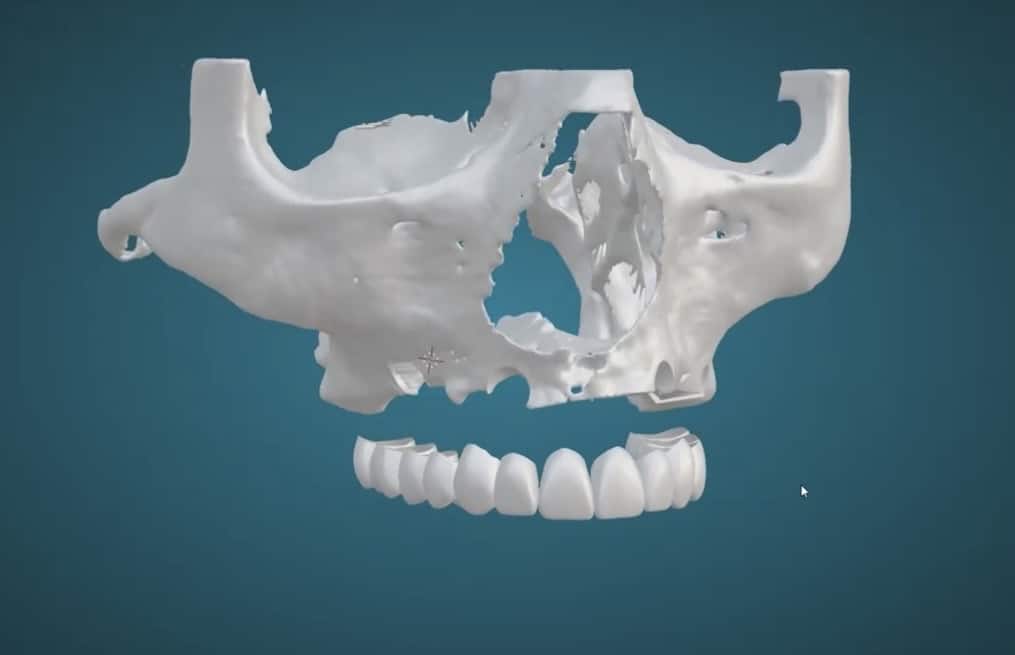 Implantataufbau