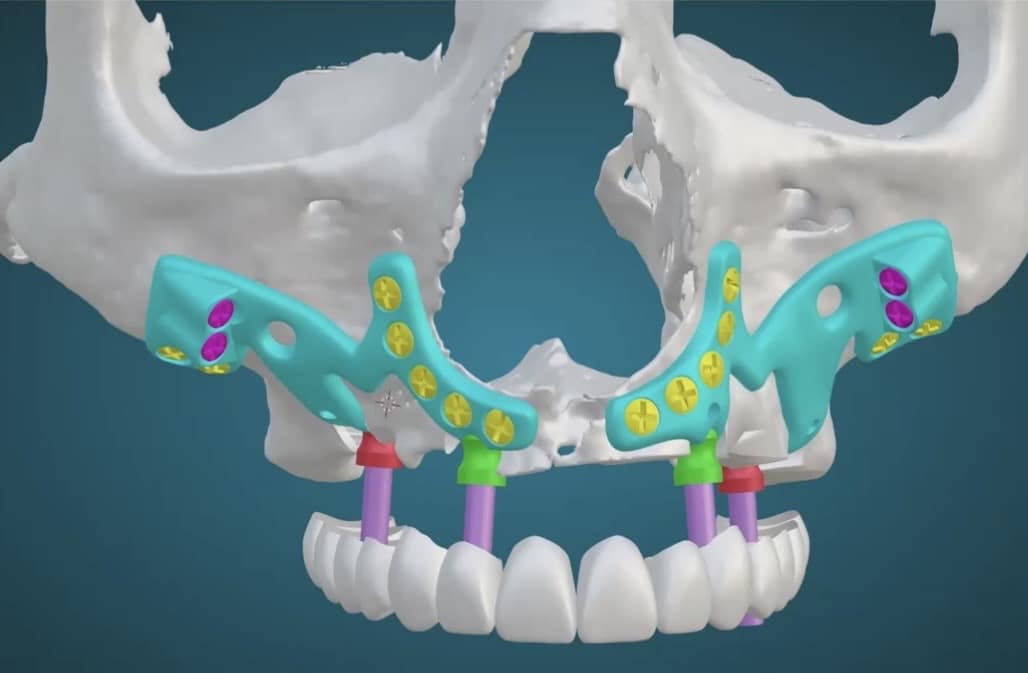 Implantataufbau